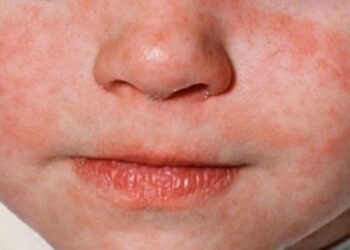 En el AICM niño originario de Rumanía es un caso importado de sarampión a México