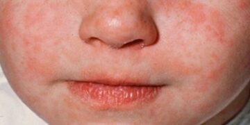 En el AICM niño originario de Rumanía es un caso importado de sarampión a México