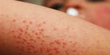 La UNAM alerta ante incremento de casos de sarampión en la CDMX