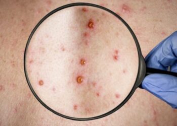 ¿Qué es el estado de alerta de la OMS por la viruela del mono?