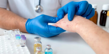 Jalisco en el top de contagios de sarampión en 2026 informa Salud