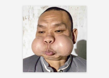 Se deformó la cara de un soplador de vidrio tras 30 años de trabajo