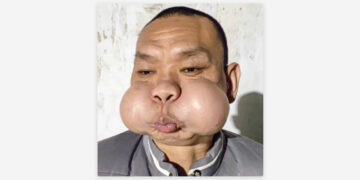 Se deformó la cara de un soplador de vidrio tras 30 años de trabajo