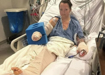 Le amputan pierna a mujer después que su perro se la dejara “colgando de un hilo”