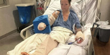 Le amputan pierna a mujer después que su perro se la dejara “colgando de un hilo”