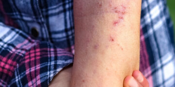 El primer caso sospechoso de sarampión en Guanajuato es un hombre que viajó a CDMX