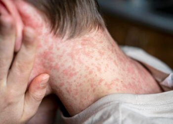 31 defunciones por el sarampión en México se reportan miles de contagios