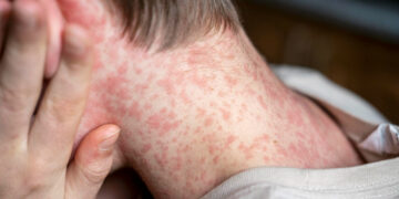 31 defunciones para el carampión en México y hay miles de contagios