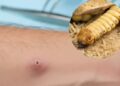 Morelos en alerta sanitaria al detectar caso de miasis humana
